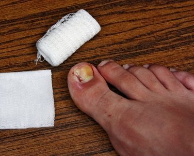 Common Toenail Problems