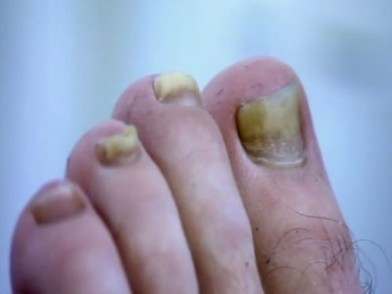 Is it Toenail Fungus?