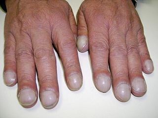 Abnormal Nails