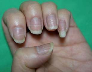 Abnormal Nails
