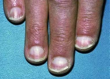 Abnormal Nails